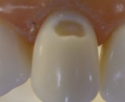 пришеечный кариес передних зубов